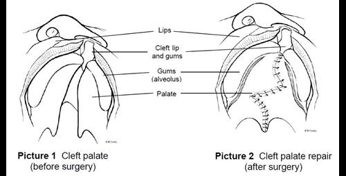 protecting the cleft palate repair