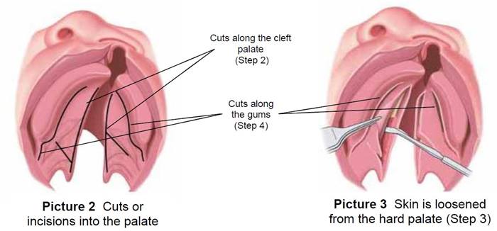 Cuts and incisions used to loosen the skin from the hard palate