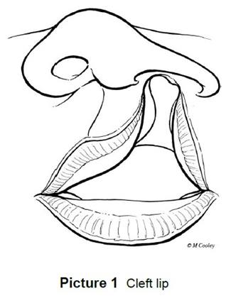 a cleft lip