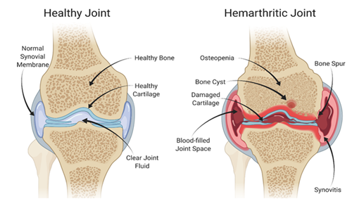 Healthy joint and hemarthrtic joint