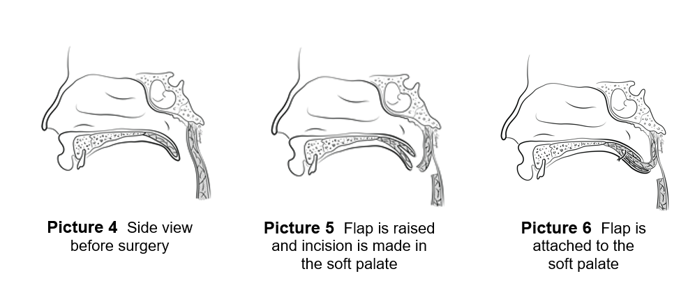 Three images demonstrating the side view before surgery, the flap raised and incision made in the soft palate, and the flap attached to the soft palate.