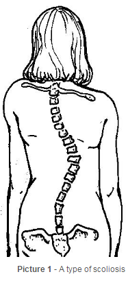 the curve of the spine when someone has scoliosis