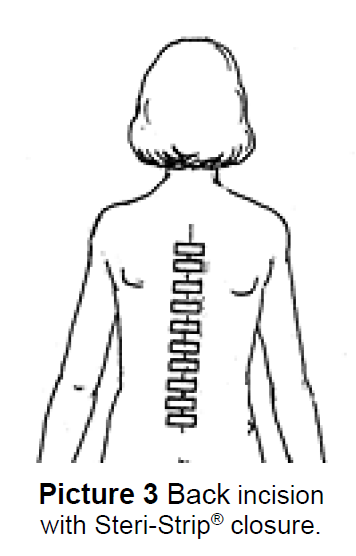 Steri-strips closing an incision on the back