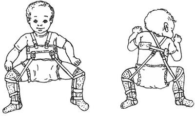 Front and back views of baby with a Pavlik harness