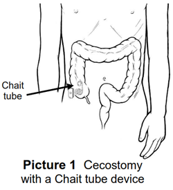 Line drawn picture of what a chait tube looks like inside the body