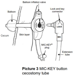 Line drawn picture of a MIC-KEY button cecostomy tube
