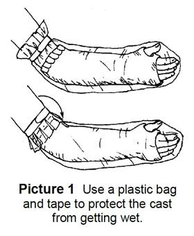 Protect Cast When Bathing