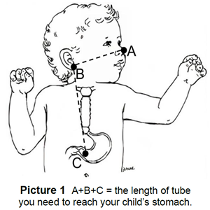 How to measure length of NG tube