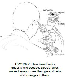 How blood looks like a microscope. Special dyes make it easy to see the types of cells and changes in them.