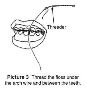 thread floss under arch wire