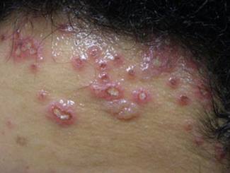 herpetic lesion